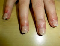 Nagelbeisser nachher