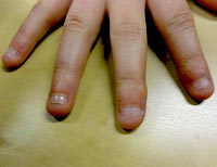 Nagelbeisser vorher